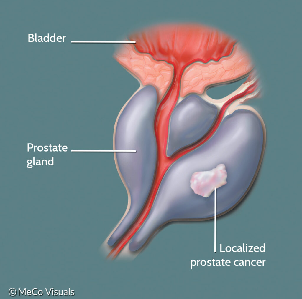 What is Localized or Locally Advanced Prostate Cancer? | PCF